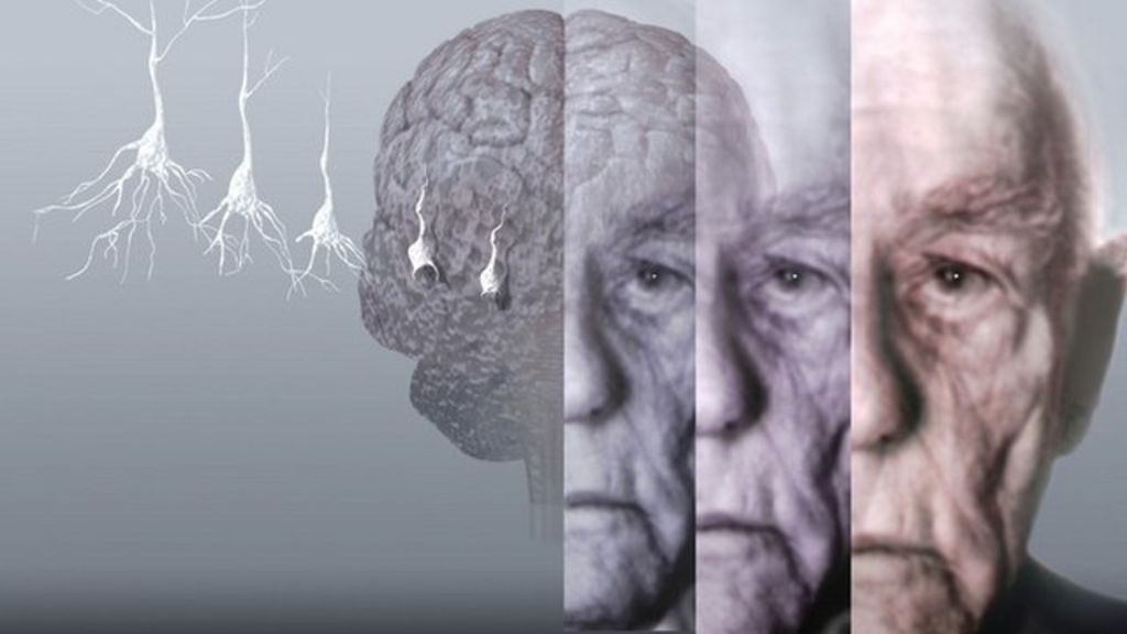Японские ученые научились диагностировать болезнь Альцгеймера по одной капле крови